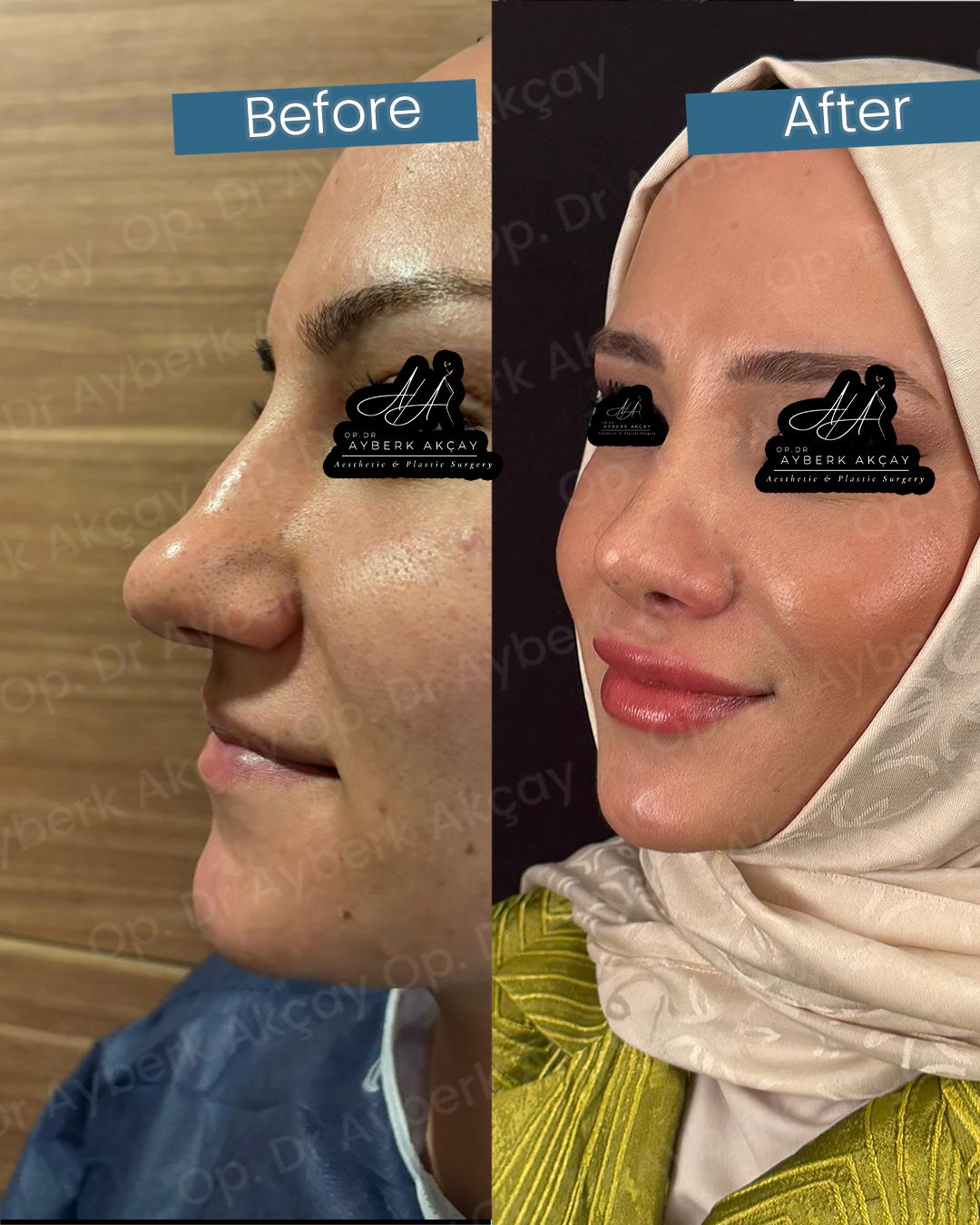 Burun estetiği muayene süreci — Op. Dr. Ayberk Akçay
